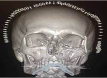 Computer generated model of Stephens skull created from CT scan (the ring above his skull are the staples used to close his scalp tissue after surgery)